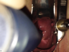 Парень через вагинальный расширитель рассматривает манду благоверной